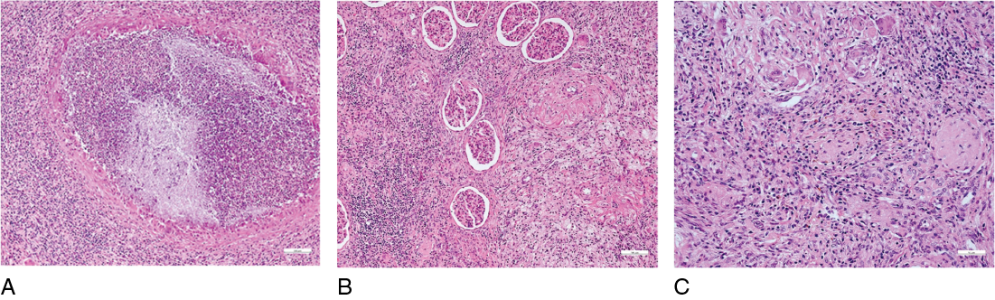 Case Report Chronic Xanthogranulomatous Pyelonephritis As A Cause Of Recurrent Episodes Of